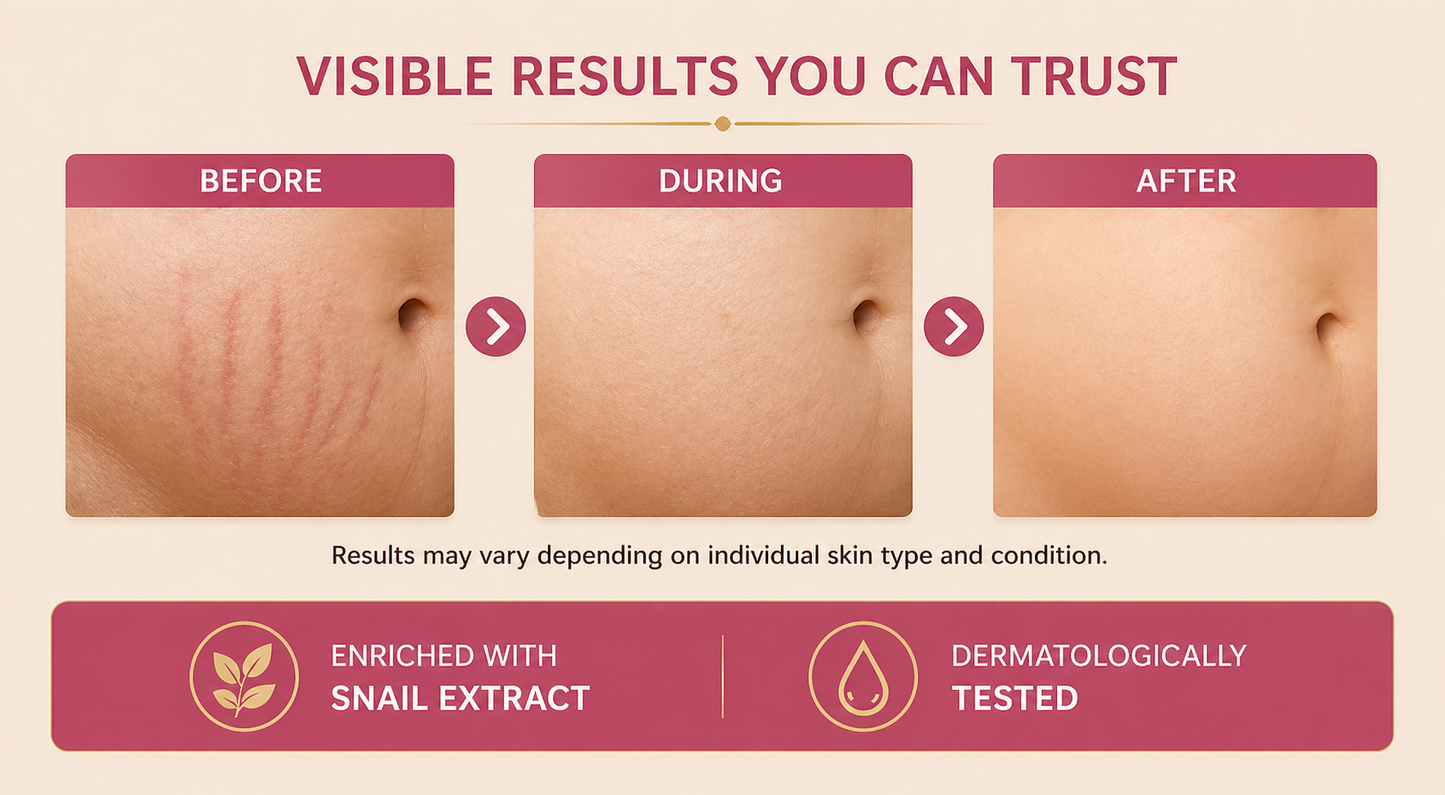 TVO Snail Stretch Marks Repair Cream – Firming & Hydration